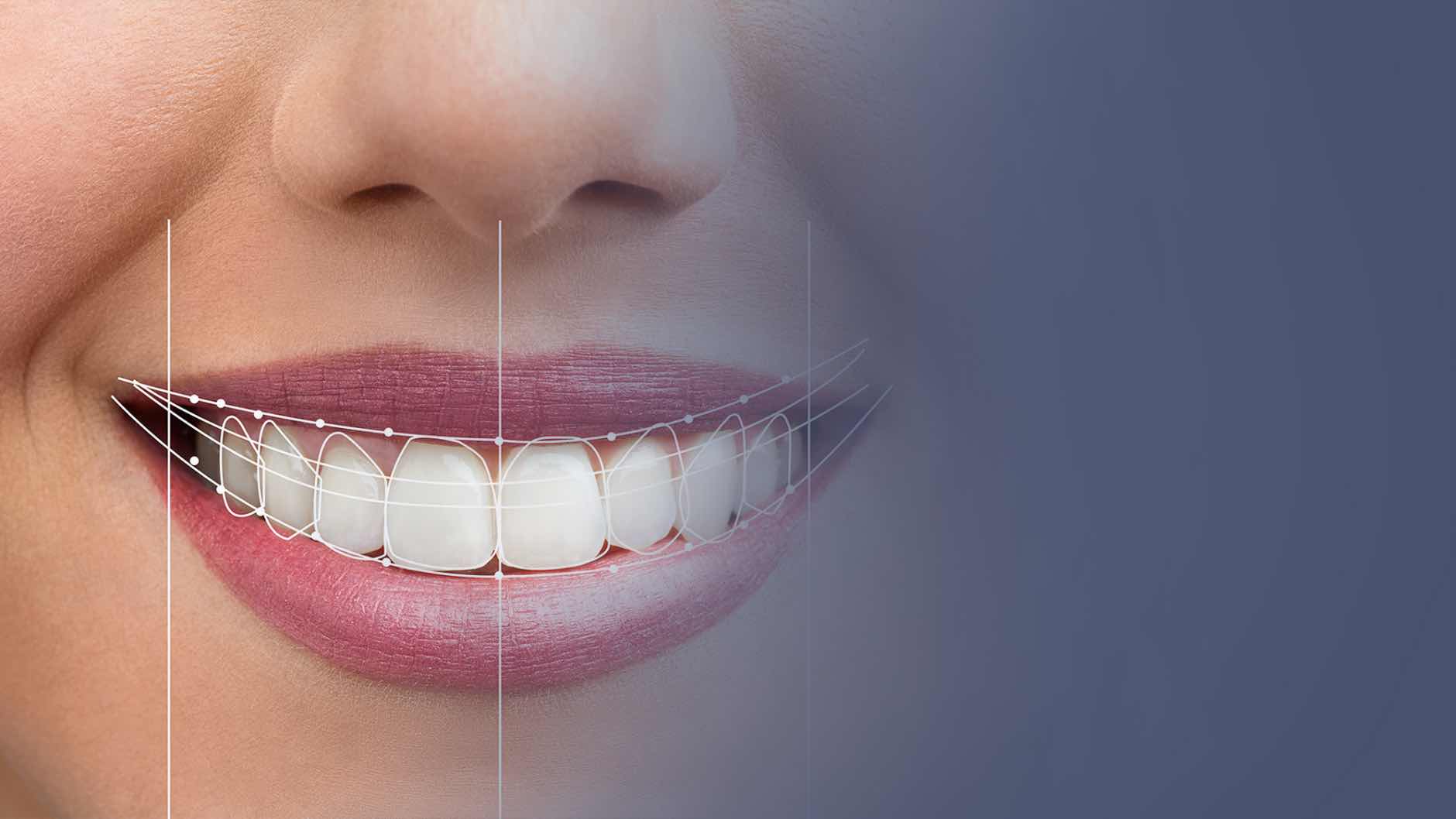 Full Smile Makeovers